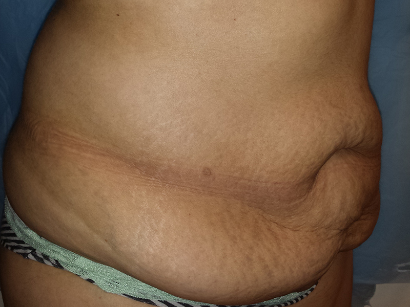 Tummy-3