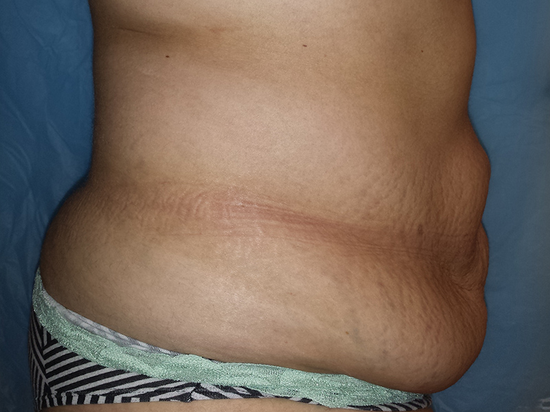 Tummy-5